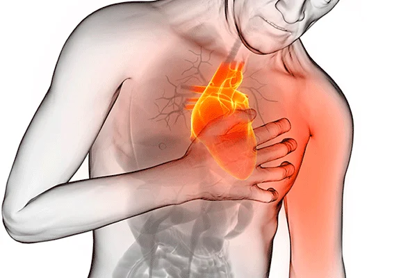 Infarto