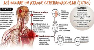 Ictus