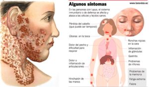 Esquema lupus